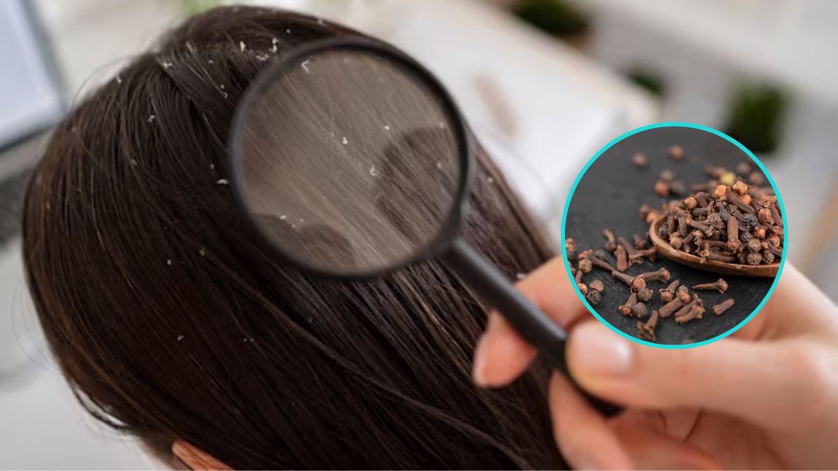 Clove Water Hair Benefits: பொடுகுத் தொல்லையை நீக்கும் கிராம்பு நீர். இப்படி பயன்படுத்துங்க.