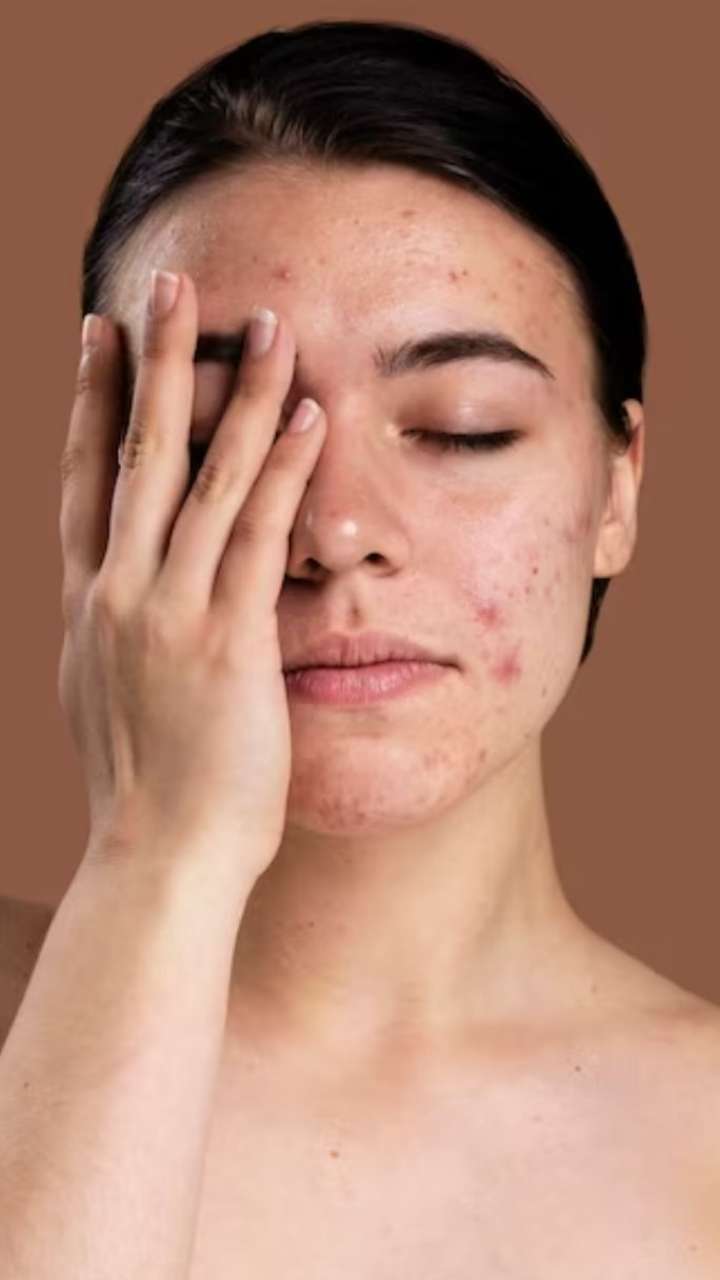 7 Home Remedies To Treat Acne In Winter