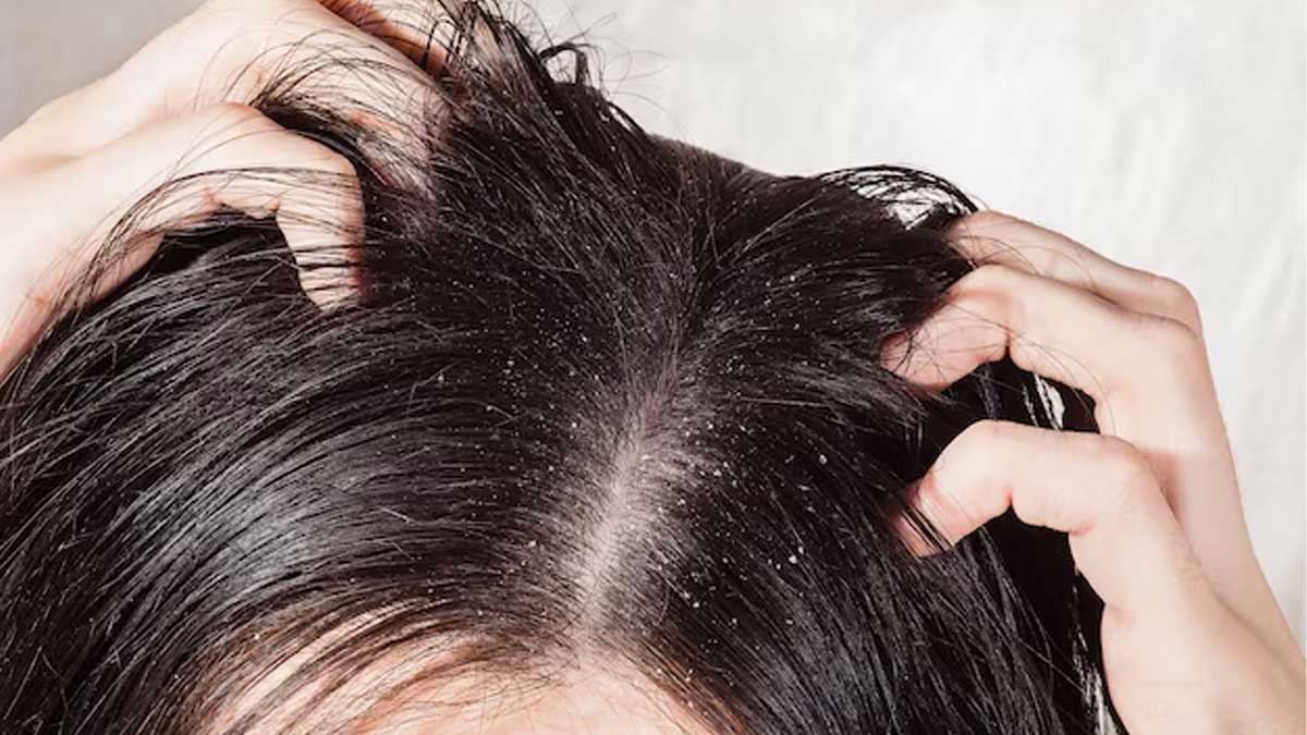 Managing Scalp Build-up: Tips to Control Sebum And Prevent Dandruff