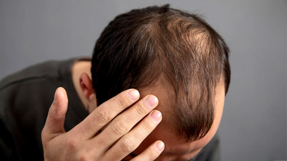 Signs Of Alopecia? Why Is It More Prevalent In Men