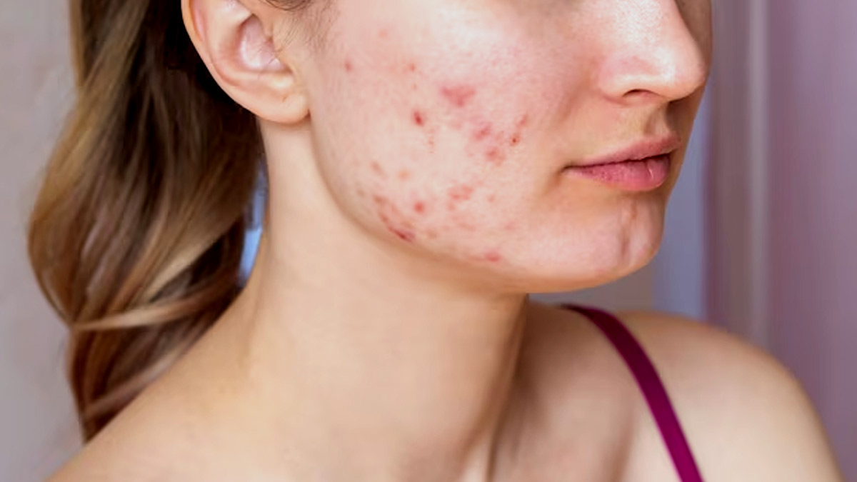 Winter and Acne: Identifying Triggers for a Clearer and Glowing Skin