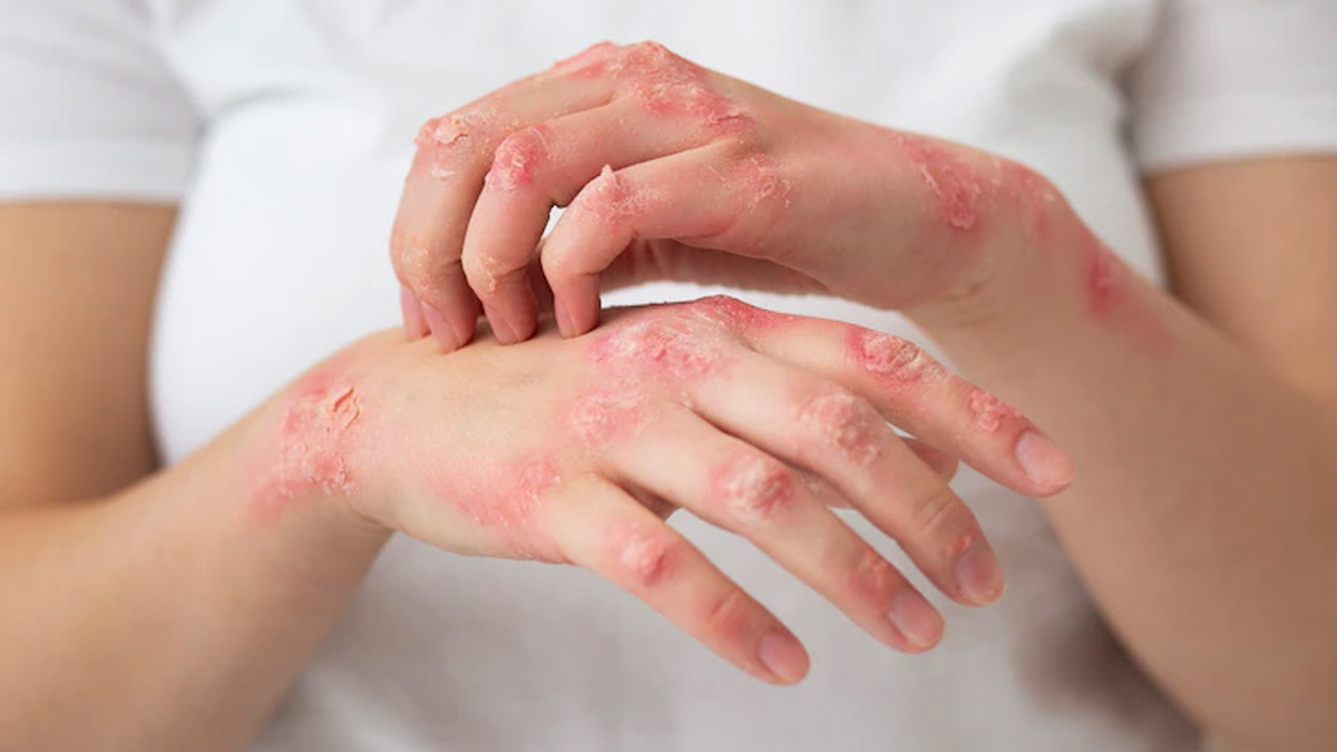 Psoriasis: Expert Explains Symptoms, Complications, And Treatment Options